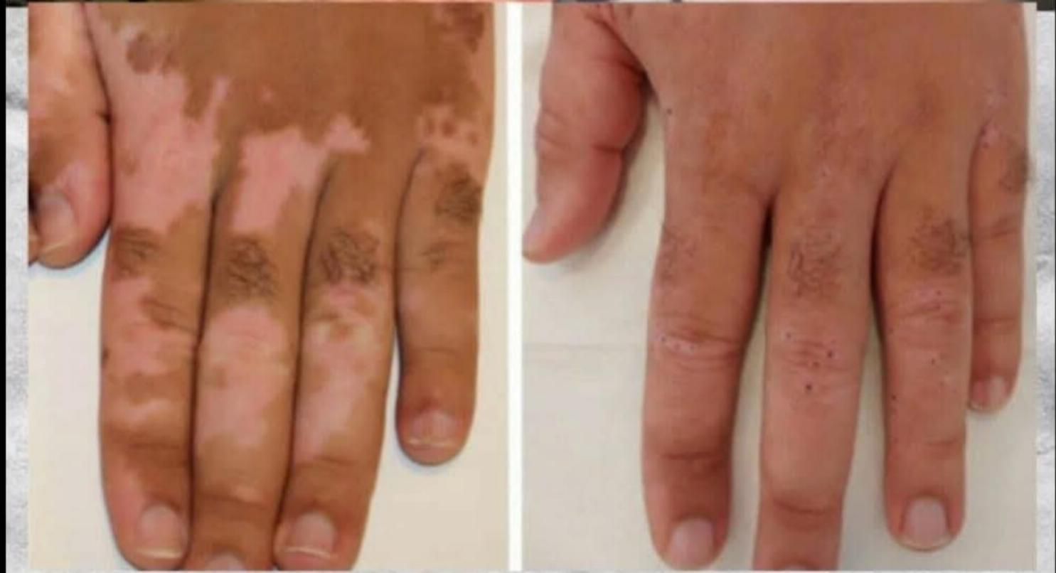 درمان ریشه یی و قطعی بیماری پیسی یا وتلیگو