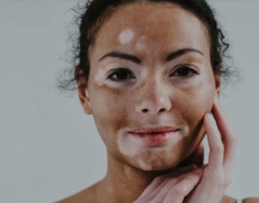 درمان ریشه یی و قطعی بیماری پیسی (ویتلیگو)