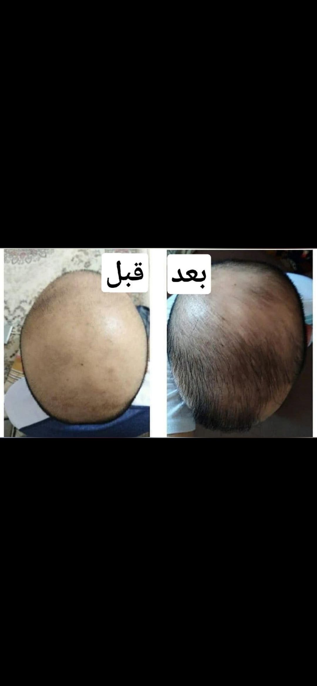 تونيک گیاهی تقویت کننده و ضد ریزش موی سر لدورا هرب