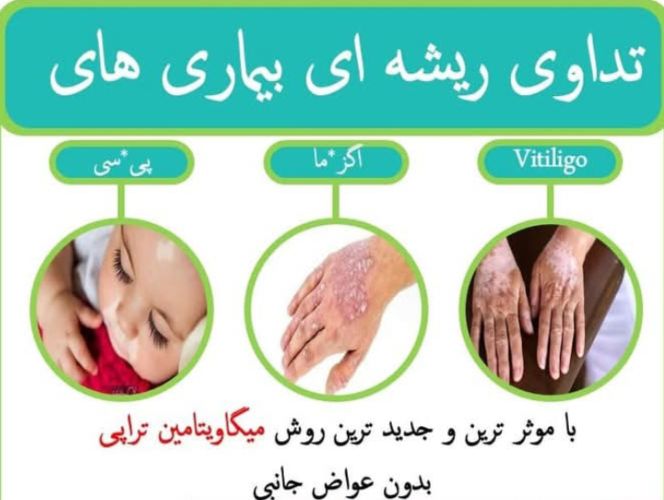 درمان قطعی بیماری پیسی پیسوریازیس اکنه اگزوما و حس