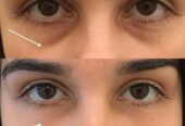 کرم رفع تیرگی و چملکی دور چشم