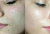 ماسک روشن کننده لکه های تاریک صورت