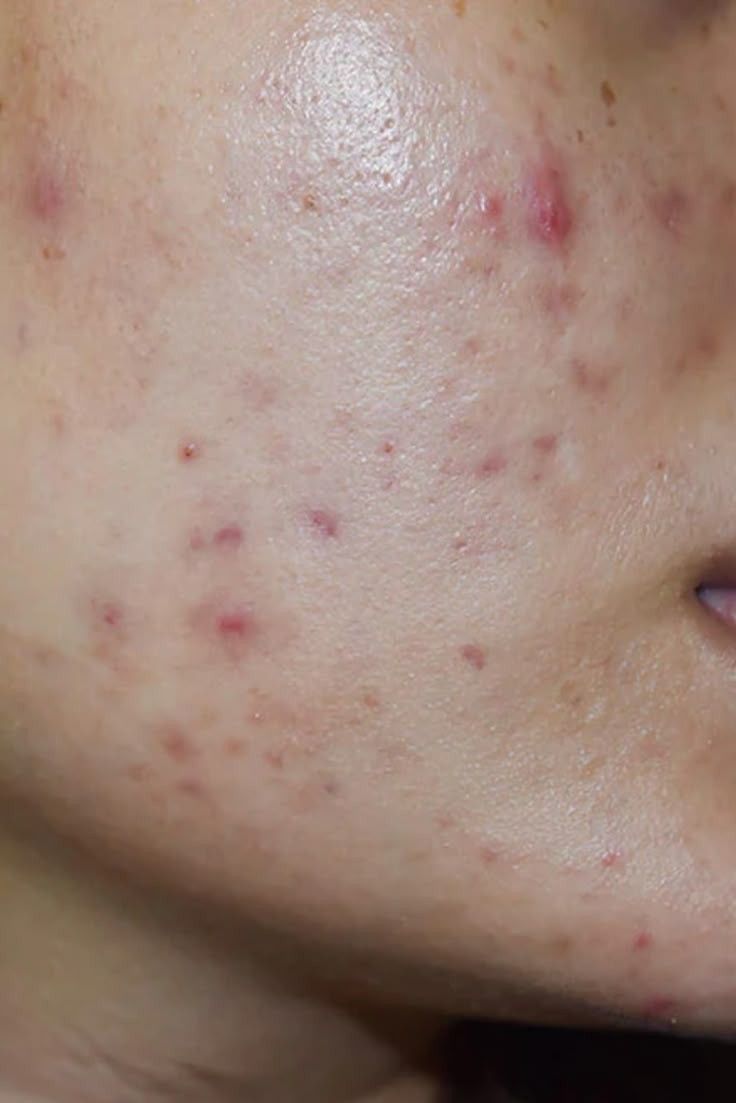 درمان جوش و آکنه (بخارهای صورت)