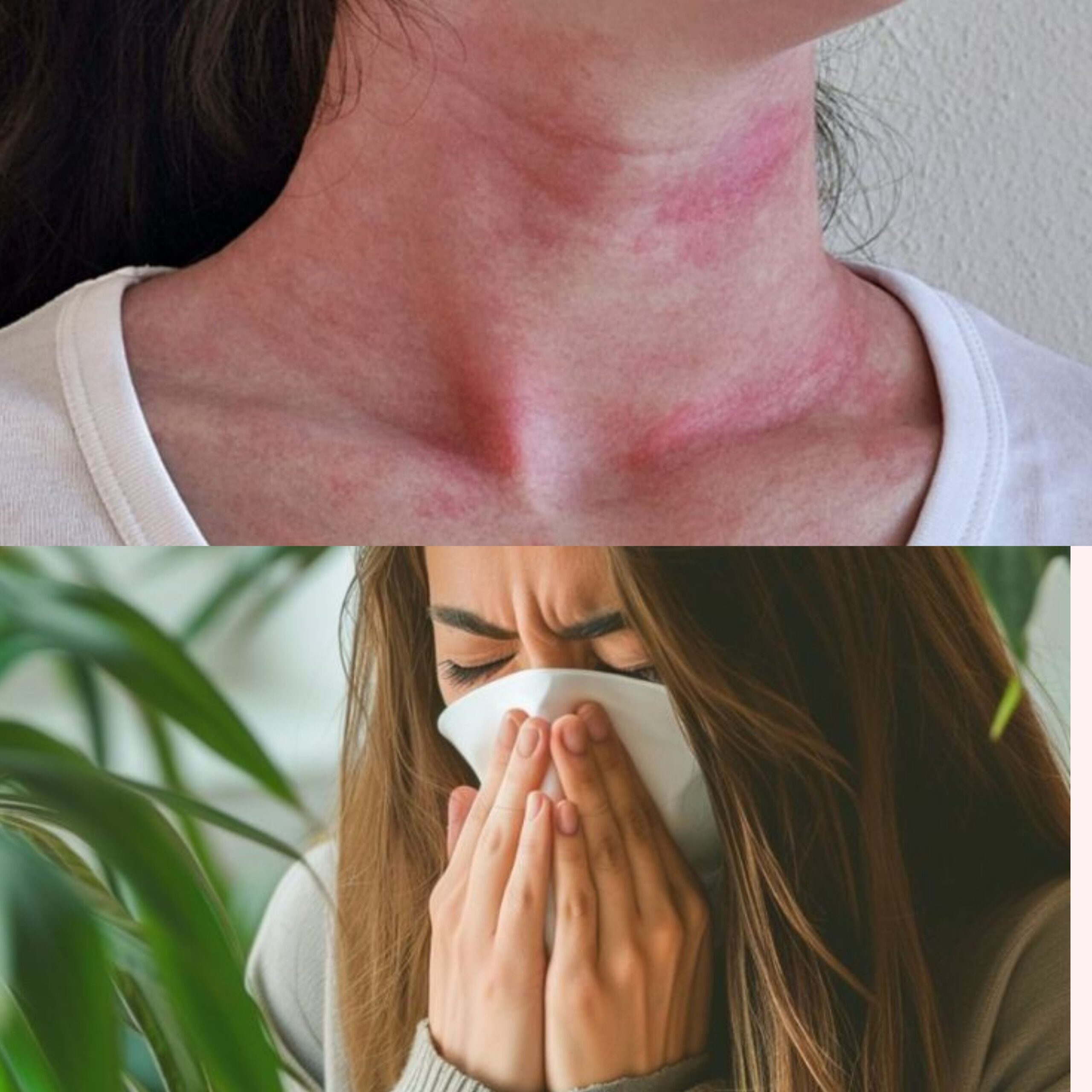 درمان آلرژی (حساسیت)