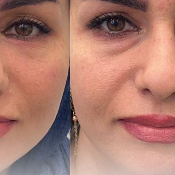 کرم رفع تیرگی و چملکی دور چشم