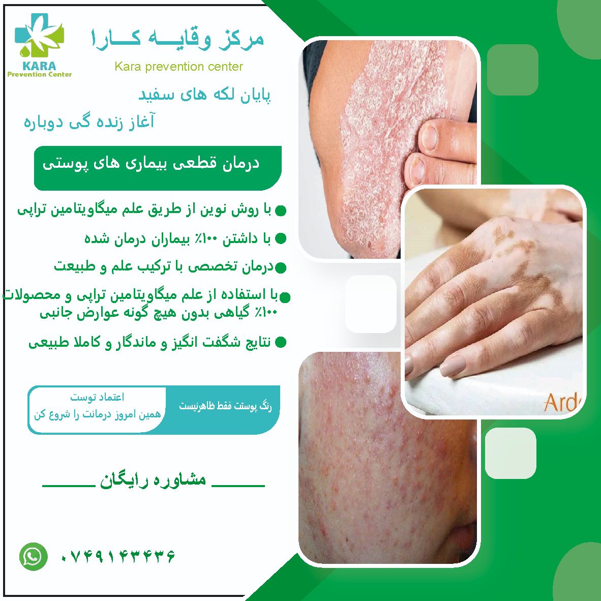 درمان بیماری پیسی و پسوریازیس