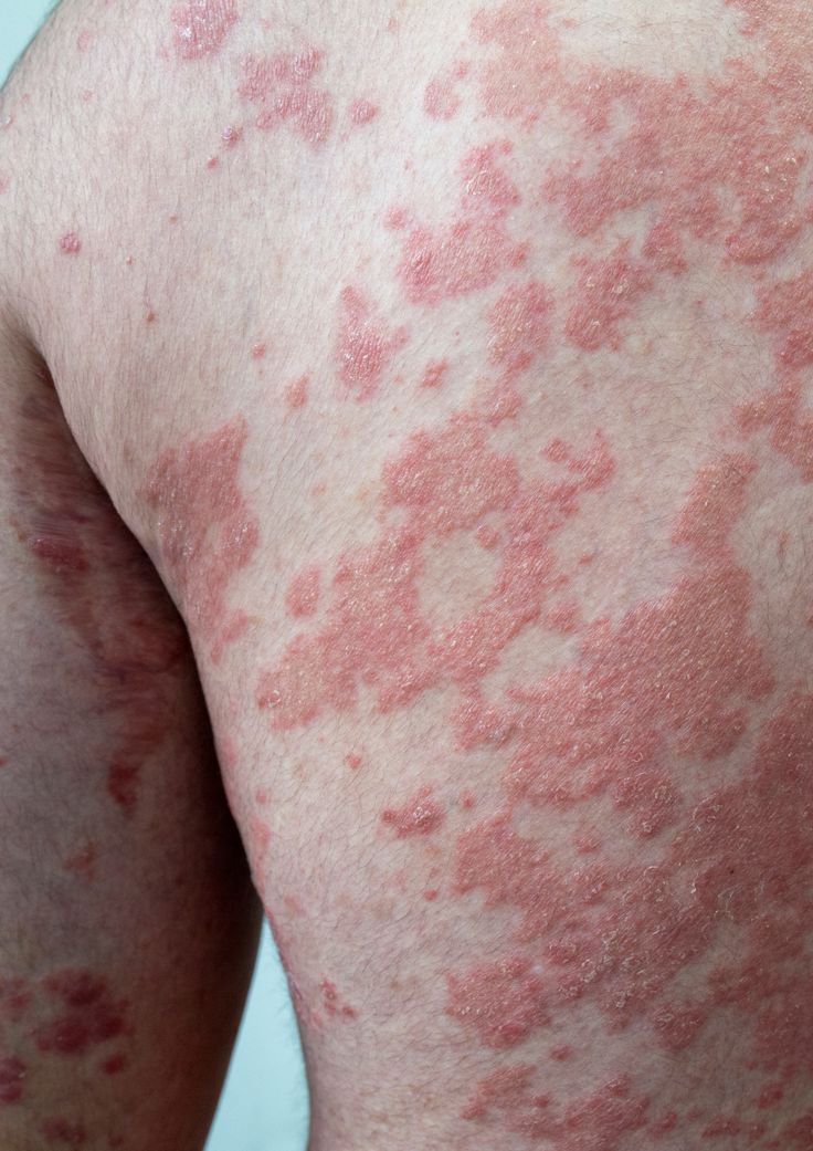 درمان هر نوع اگزما پوستی