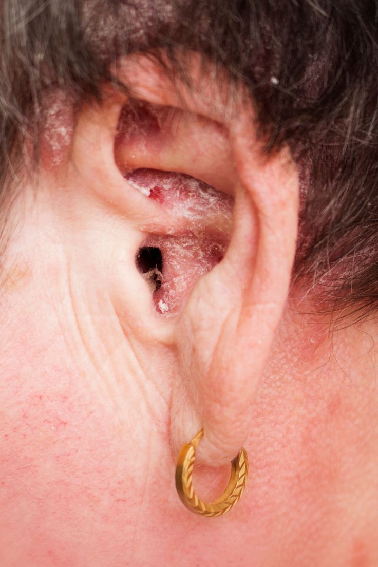 درمان پسوریازیس