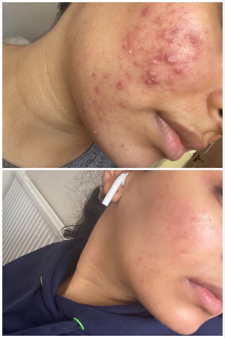 درمان آکنه (بخار)