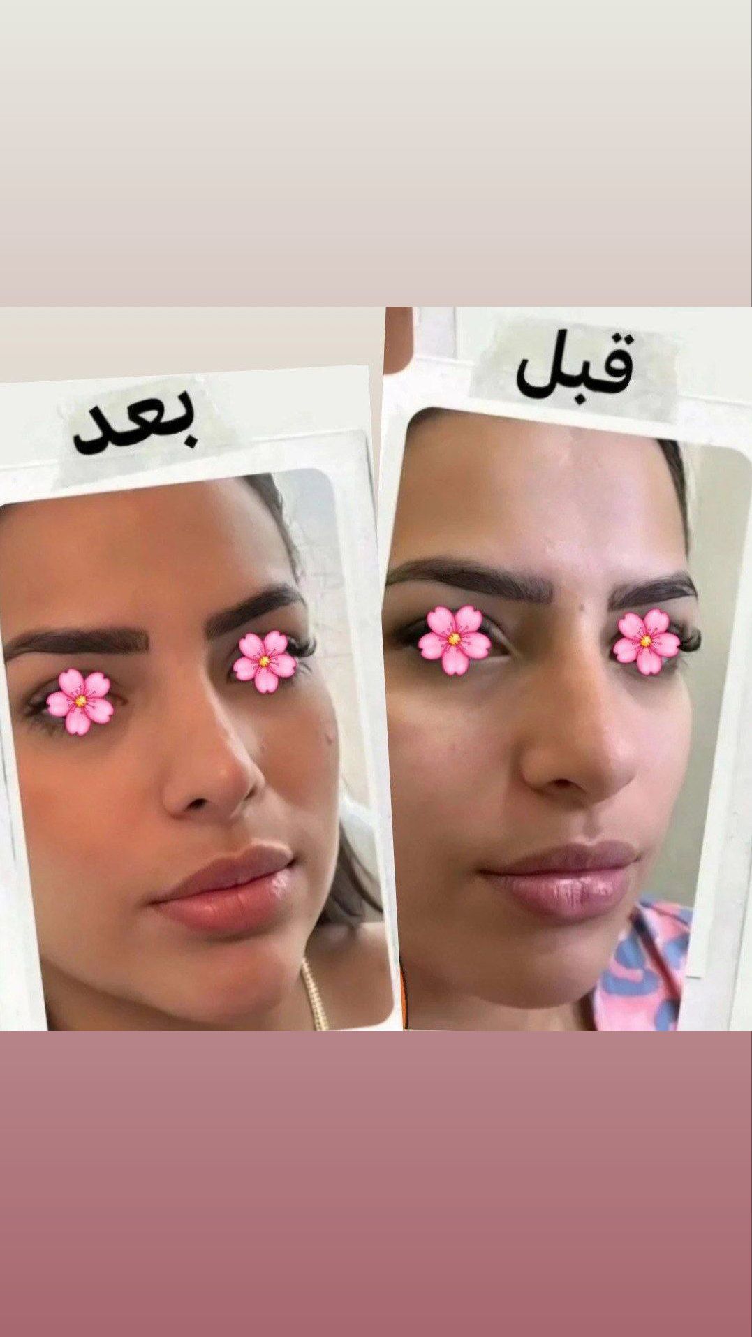 لک و جوش صورت،ریزش مو و کچلی،کوچک شدن بینی