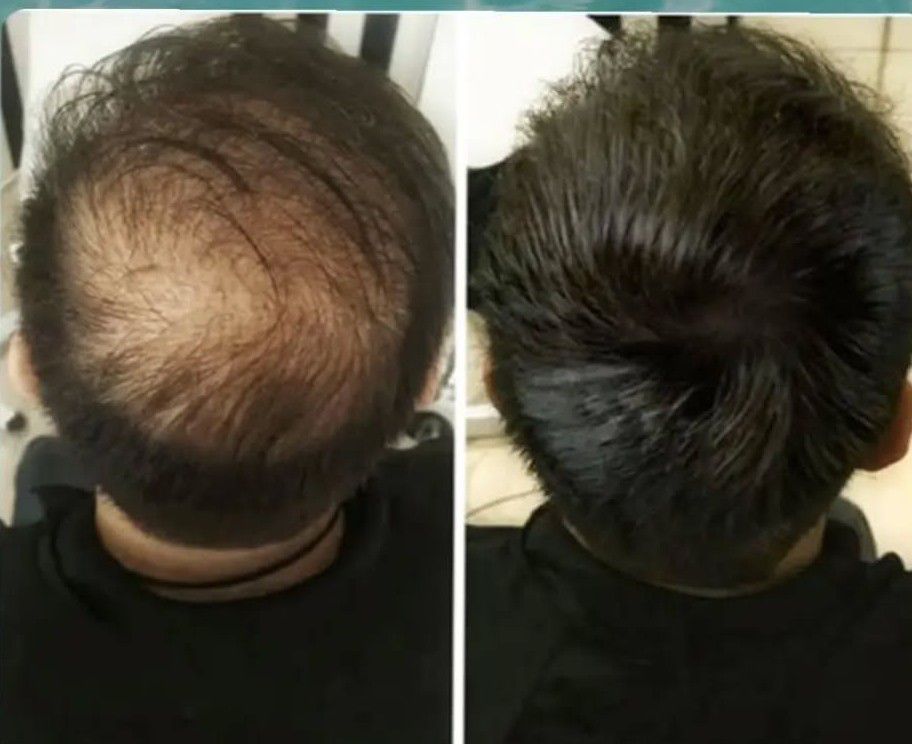 لک و جوش صورت،ریزش مو و کچلی،کوچک شدن بینی