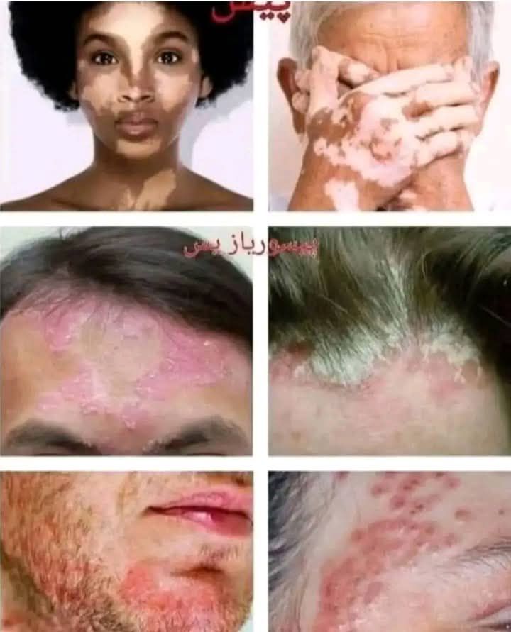 در مان بیماری پسوریازیس و پس